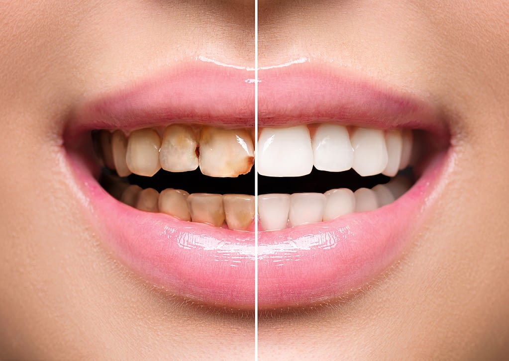 before and after results to get yellow teeth white again
