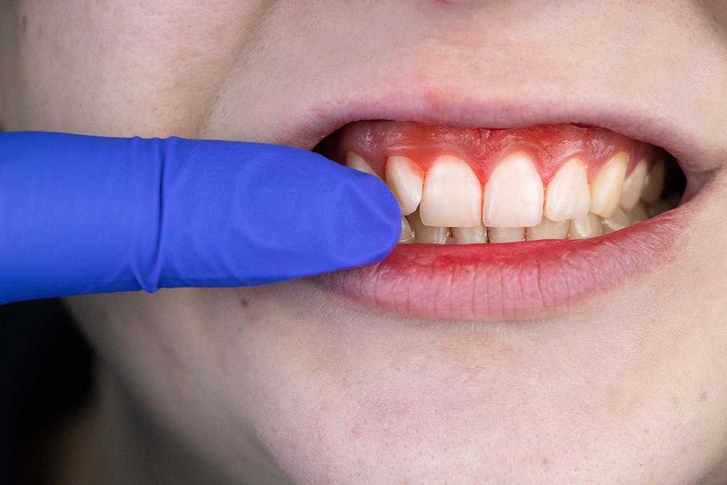 patient with gum irritation