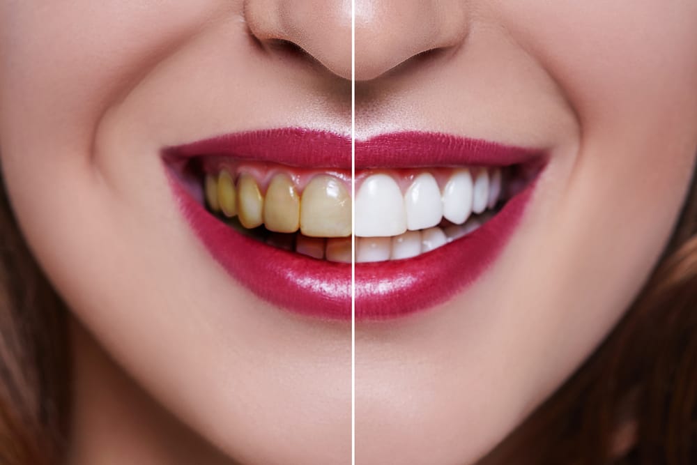 how-to-get-rid-of-yellow-teeth-naturally-vineyard-dental